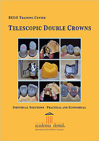 Telescopic double crowns: Individual solutions – practical and economical