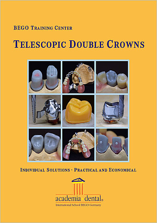 Telescopic double crowns – Individual Solutions • Practical and Economical