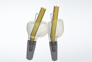 From now on, BEGO offers angulated screw channels for one-piece bridge and bar restorations in which the alignment of the screw access channel within the prosthetic restoration can be individually selected from 0° to 20° to the implant position. 