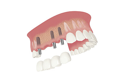 Kronen und Brückenversorgung