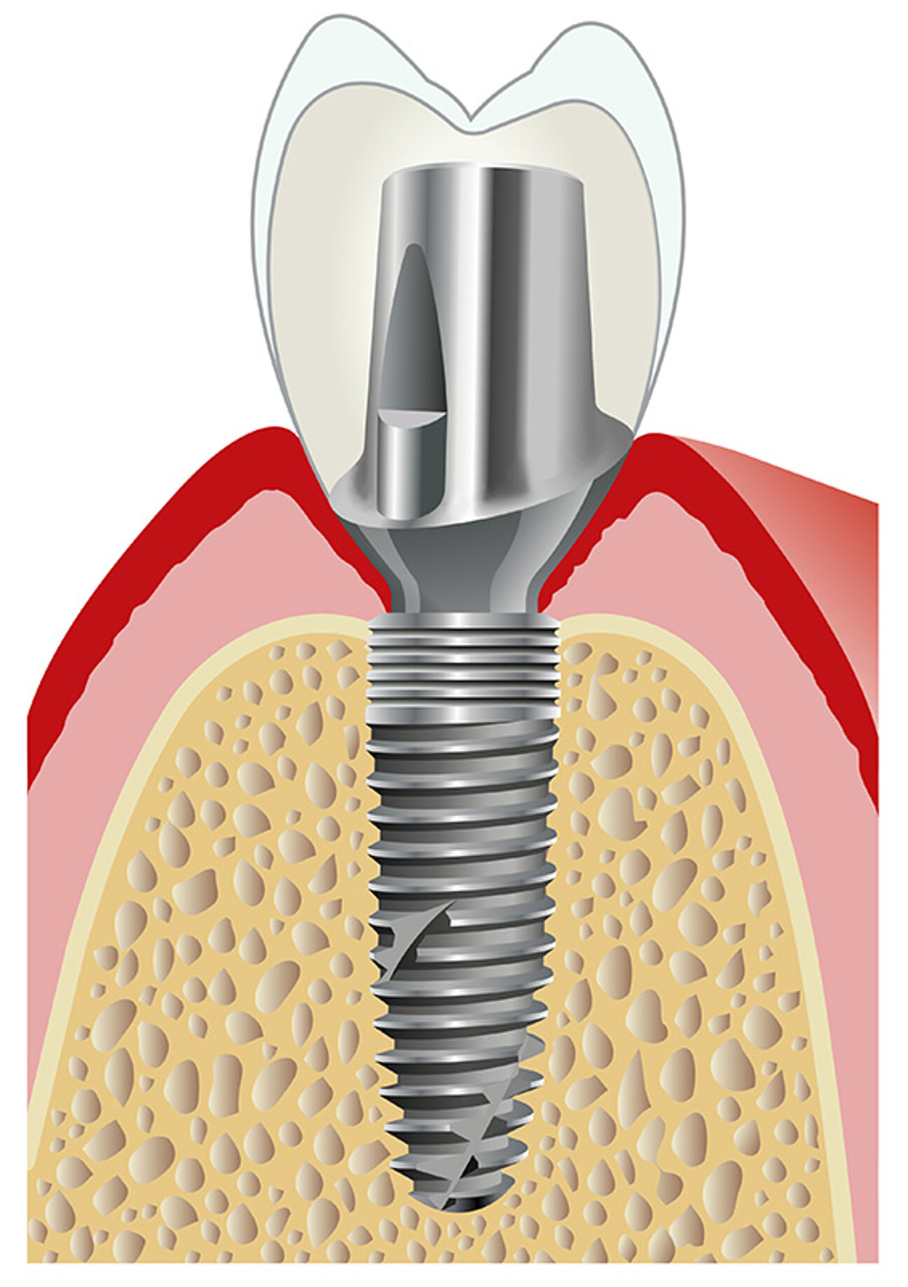 RSX Implant with PS-Line abutment