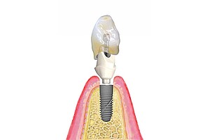 Exploded view of a BEGO Semados® restoration