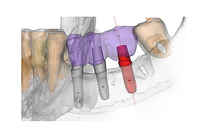 Navigierte Chirurgie