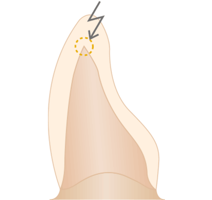Vermeiden von spitzen Kanten