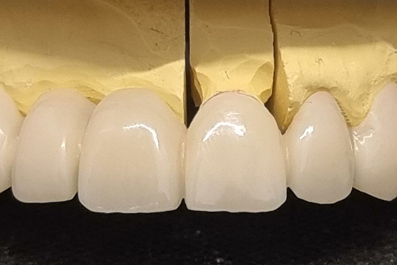 std_1K_SmartVeneering_Model-3