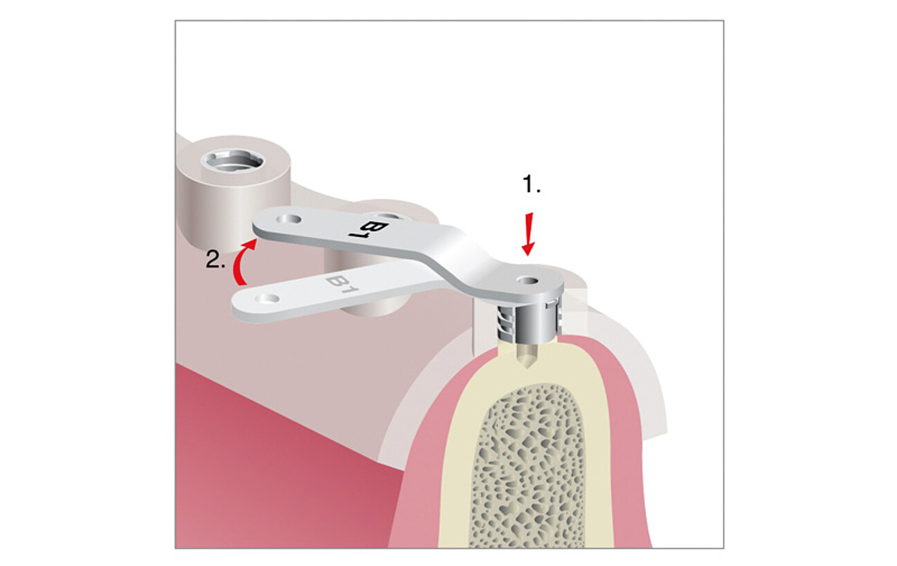 Self-locking BEGO Guide Spoon – for even more convenient completely guided implant placement 