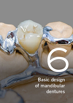 Partial dentures – Basic design of mandibular dentures, Part 6