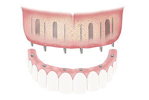 Schematische Darstellung einer provisorischen Versorgung mit BEGO Semados® Provisorischen Implantaten