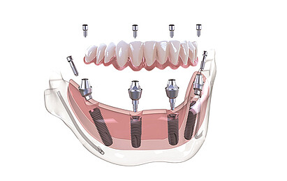 MultiPlus Versorgung