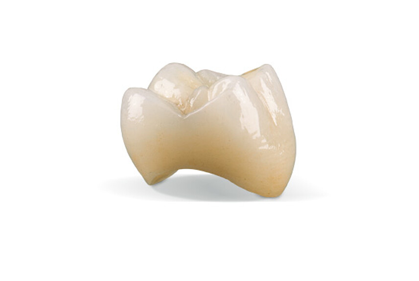 Fully anatomical crowns made of IPS e.max CAD