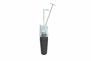 Ab sofort bietet BEGO abgewinkelte Schraubenkanäle für einteilige Einzelzahnversorgungen an, bei denen die Ausrichtung des Schraubenzugangskanals innerhalb der prothetischen Versorgung von 0° bis 20° zur Implantatposition individuell wählbar ist.