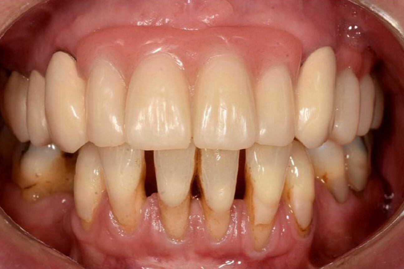 std_1K_SmartVeneering_klinische-Situation