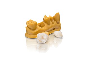 VarseoSmile Crown – the first Varseo material for the 3D printing of permanent single crowns